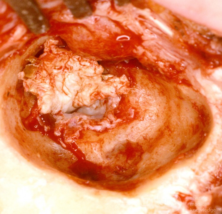 Mastoidectomía por absceso mastoideo