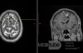 Estirpación de cavernoma subcortical 