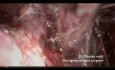 Tratamiento laparoscópico del cáncer de ovario temprano