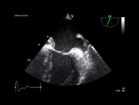 Ecocardiografía transesofágica y una revisión de algunos puntos de vista básicos