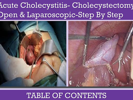 Colecistitis aguda y colecistectomía: abierta y laparoscópica