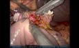 Pancreatoduodenectomía robótica con preservación del píloro