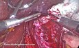 Miotomía de Heller laparoscópica para megaesófago extremo: una alternativa a la esofagectomía