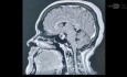 Abordaje transeptal para resección de adenoma de fosa aprobado con TC