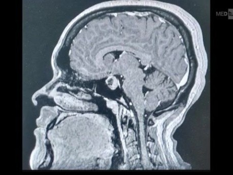 Abordaje transeptal para resección de adenoma de fosa aprobado con TC
