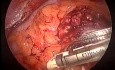 Resección abdominoperineal del recto