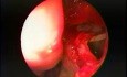 Antrostomía del seno maxilar - intranasal, endoscópica