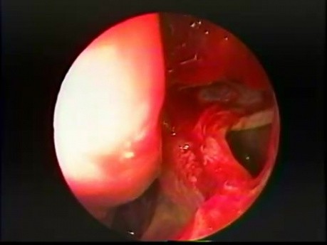 Antrostomía del seno maxilar - intranasal, endoscópica