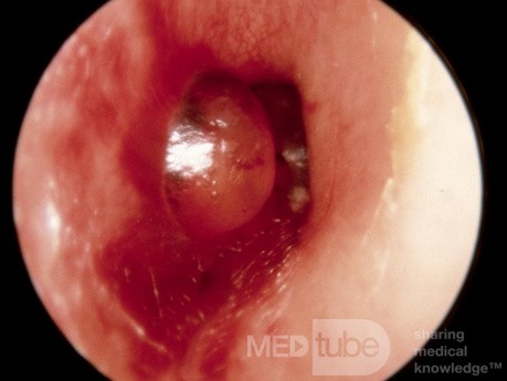 Miringitis bullosa, caso 2