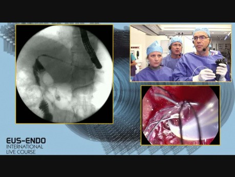 Extracción de FCSEMS e inserción de 2 o 3 stents de plástico para calibrar la anastomosis