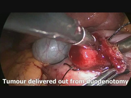 Resección transduodenal laparoscópica de un tumor neuroendocrino duodenal