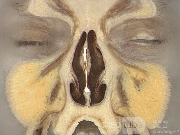 Anatomía coronal de la nariz y los senos paranasales: Corte 3