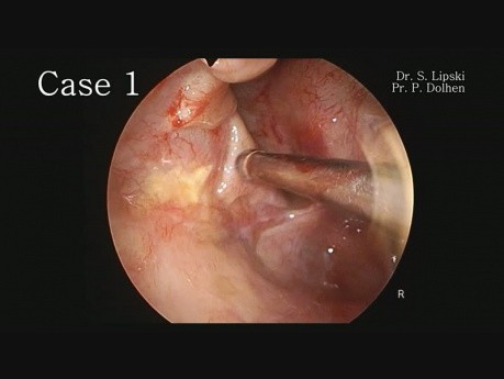 2 casos de mucocele