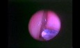 Cirugía endoscópica funcional de los senos nasales - demostración anatómica - parte 1 de 5