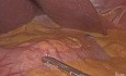 Gastrectomía subtotal + D1 laparoscópica
