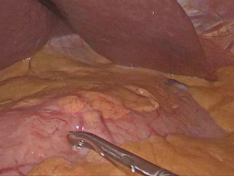 Gastrectomía subtotal + D1 laparoscópica