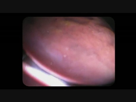 Colonoscopia - pólipos omitidos después de una mala preparación intestinal