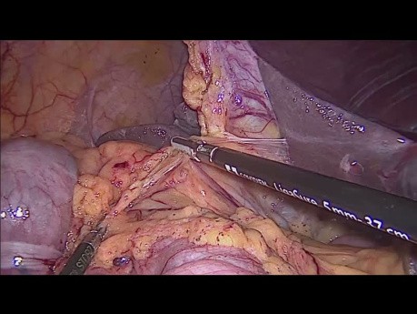 Hemicolectomía derecha laparoscópica con anastomosis intracorpórea