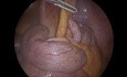 Apendicitis aguda