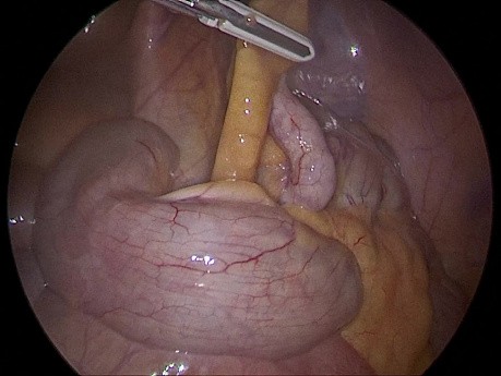 Apendicitis aguda