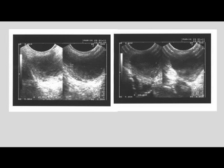 Hematoma vulvar en niña de 9 años. Seguimiento clínico y ecográfico.