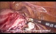 Técnica de Goel de histerectomía laparoscópica para el carcinoma de endometrio