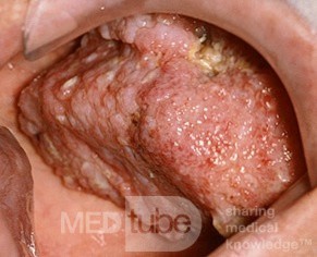 Carcinoma verrugoso del paladar