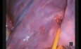 Bilobectomía segmentectomía de la parte superior del lóbulo inferior mediante VATS uniportal