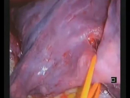 Bilobectomía segmentectomía de la parte superior del lóbulo inferior mediante VATS uniportal