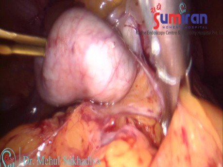 Histerectomía total laparoscópica en un caso de endometriosis avanzada