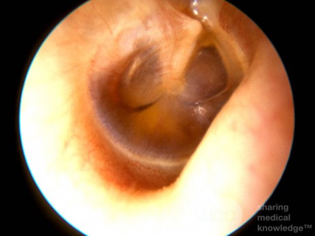 Menisco hidroaéreo de otitis media serosa