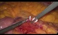 Resección sigmoidea laparoscópica por cáncer
