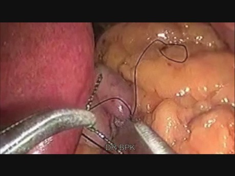 Mini-bypass gástrico por laparoscopia 