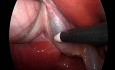 Litiasis vesicular
