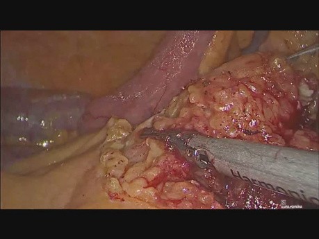 Resección laparoscópica de intestino delgado y mesenterio para adenocarcinoma