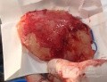 Craniectomía descompresiva en infarto maligno de la arteria cerebral media