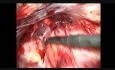 Reparación laparoscópica de hernia inguinal - paso 5 - preparación del lado izquierdo
