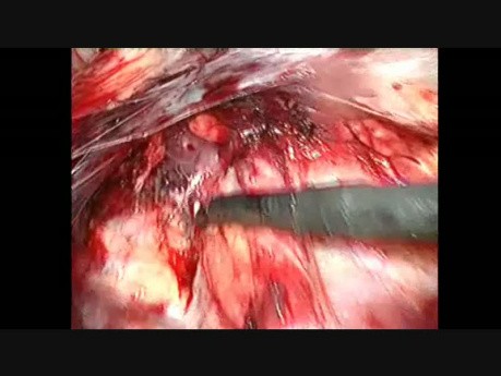 Reparación laparoscópica de hernia inguinal - paso 5 - preparación del lado izquierdo