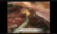 Histerectomía laparoscópica    