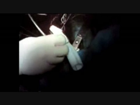 Dispositivo expandible para anastomosis aórtica en un caso de cáncer de ULL que se infiltra en el arco aórtico distal