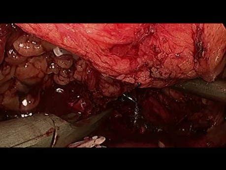 Video de Nefrectomia Radical Derecha Laparoscopica con Adrenalectomia Bilateral