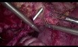 Reimplante Uretero-Vesical Laparoscópico