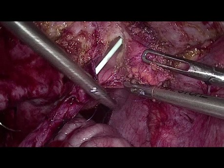 Reimplante Uretero-Vesical Laparoscópico