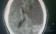 Craniectomía descompresiva en infarto maligno de la arteria cerebral media