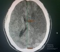 Craniectomía descompresiva en infarto maligno de la arteria cerebral media