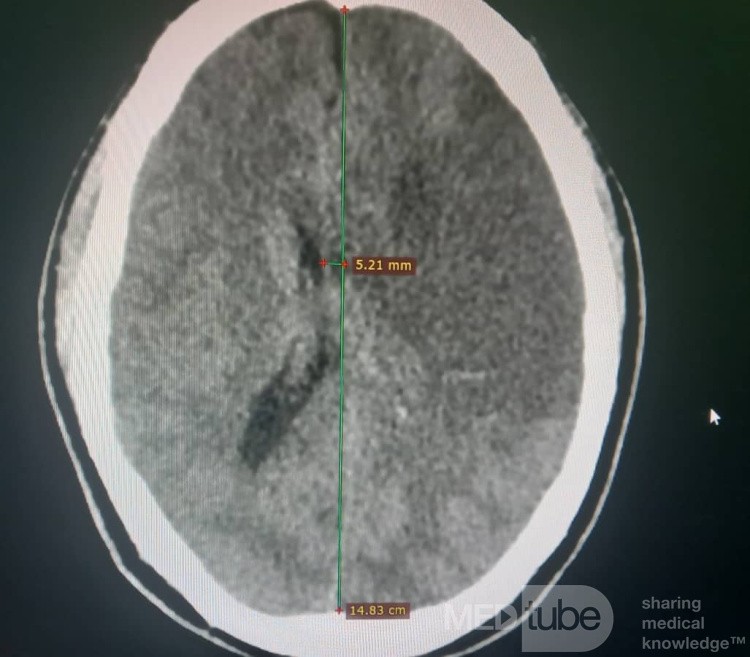 Craniectomía descompresiva en infarto maligno de la arteria cerebral media