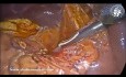 Exploración laparoscópica del colédoco y coledocoduodenostomía