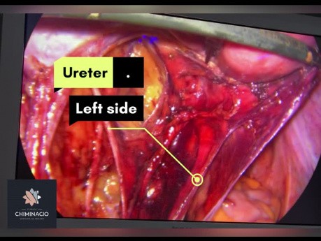 Tratamiento mediante peritonectomía de la endometriosis del nervio obturador 