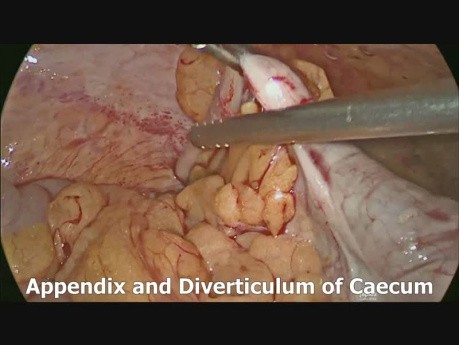 Diverticulectomía Cecal Solitaria por la Laparoscopia