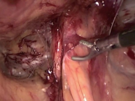 Hernia inguinal - cirugía - método TAPP